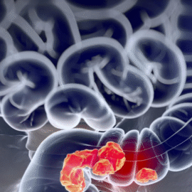 Câncer de intestino: especialista de Harvard indica alimento que previne a doença Câncer de intestino: especialista de Harvard indica alimento que previne a doença