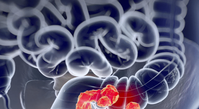 Câncer de intestino: especialista de Harvard indica alimento que previne a doença Câncer de intestino: especialista de Harvard indica alimento que previne a doença