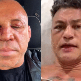Popó passa por cirurgia e Wanderlei Silva faz novos exames após pancadaria no ringue